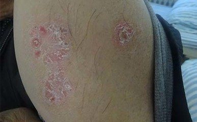 泉州晉江市看牛皮癬醫(yī)院哪家比較專(zhuān)業(yè)